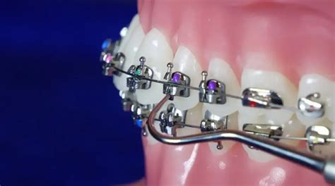 tipos de brackets metalicos autoligables|tratamiento de brackets autoligables.